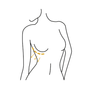 Woman's body illustration highlighting the location of the Breast Augmentation surgery