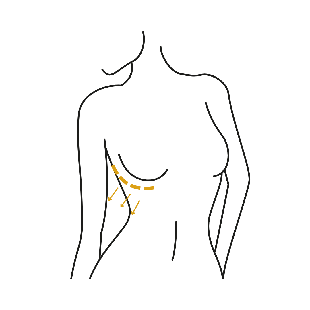 Woman's body illustration highlighting the location of the Breast Augmentation surgery