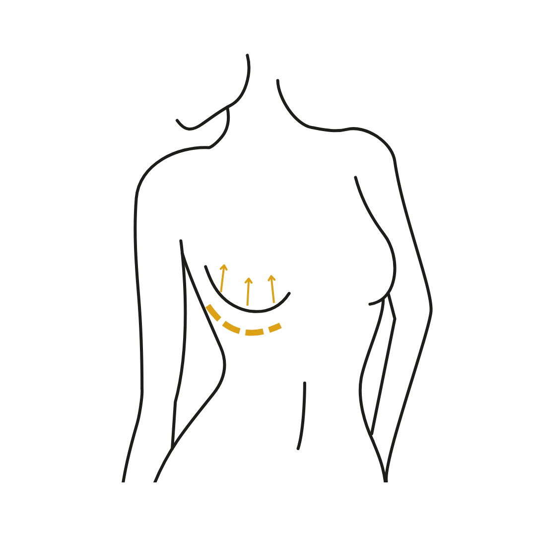 Woman's body illustration highlighting the location of the Breast lift surgery