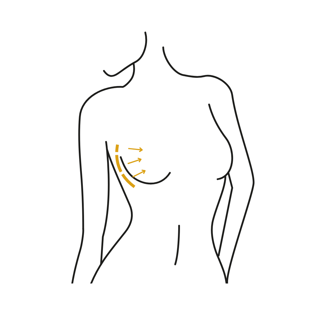 Woman's body illustration highlighting the location of the Breast reduction surgery